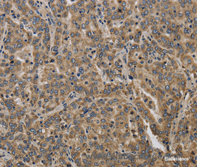 Immunohistochemistry of paraffin-embedded Human liver cancer tissue using KCNMB2 Polyclonal Antibody at dilution 1:40