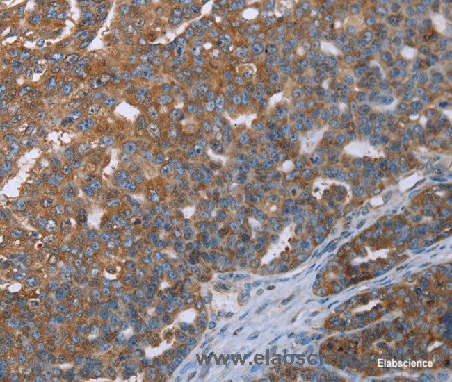 Immunohistochemistry of paraffin-embedded Human ovarian cancer tissue using CERS4 Polyclonal Antibody at dilution 1:35