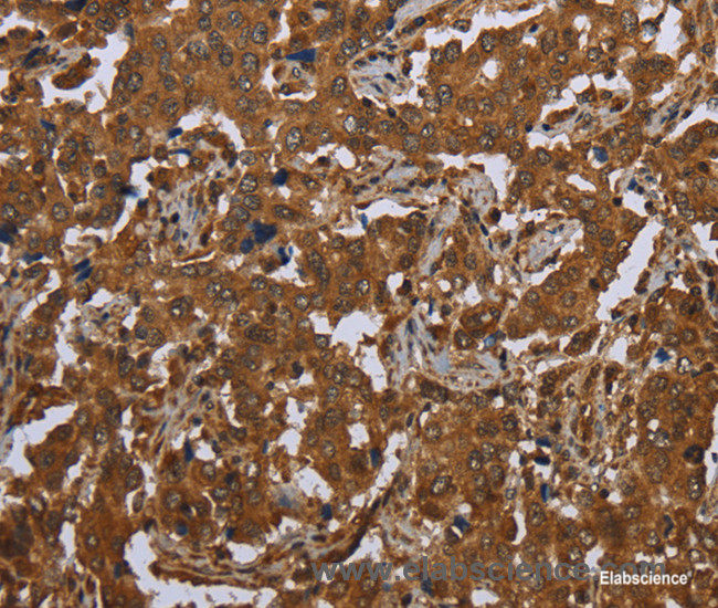 Immunohistochemistry of paraffin-embedded Human liver cancer tissue using SCGB1D2 Polyclonal Antibody at dilution 1:40