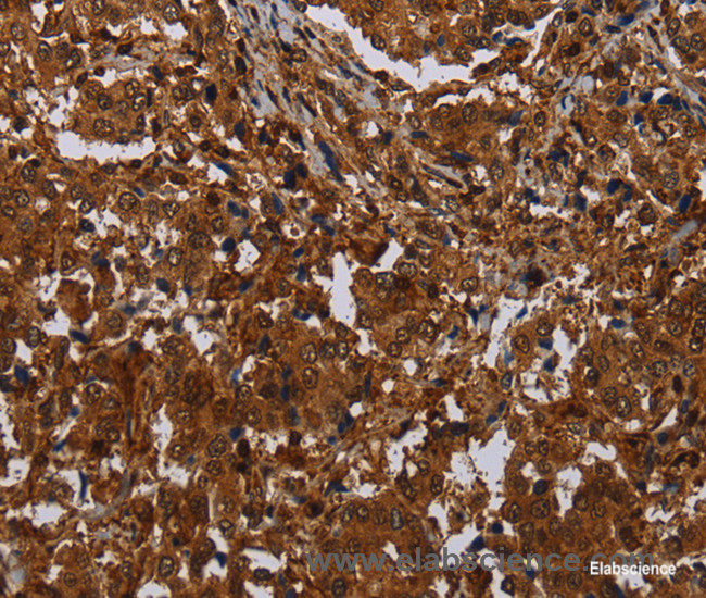 Immunohistochemistry of paraffin-embedded Human liver cancer tissue using MAGEB18 Polyclonal Antibody at dilution 1:30