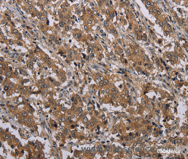 Immunohistochemistry of paraffin-embedded Human liver cancer tissue using MAL Polyclonal Antibody at dilution 1:30