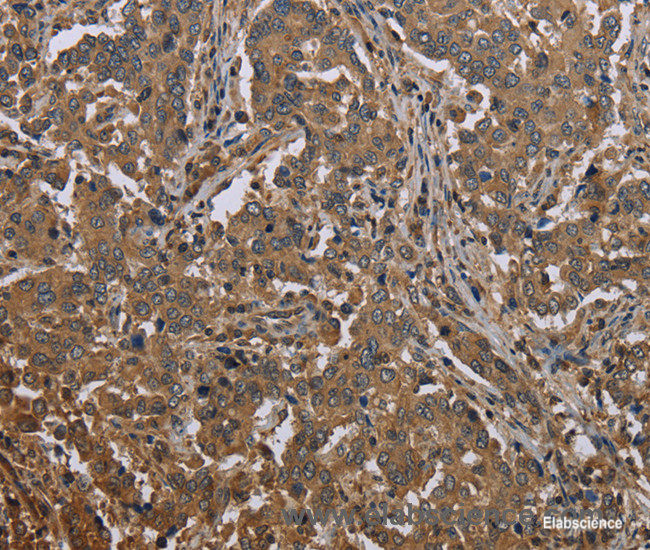 Immunohistochemistry of paraffin-embedded Human liver cancer tissue using MCC Polyclonal Antibody at dilution 1:30