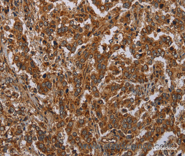 Immunohistochemistry of paraffin-embedded Human liver cancer tissue using ATP2A1 Polyclonal Antibody at dilution 1:30