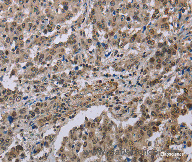 Immunohistochemistry of paraffin-embedded Human liver cancer tissue using MGLL Polyclonal Antibody at dilution 1:40