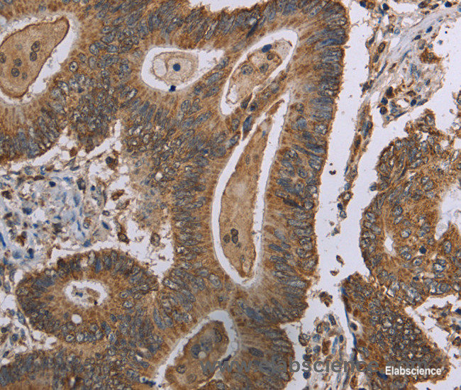 Immunohistochemistry of paraffin-embedded Human colon cancer tissue using MRGPRX1 Polyclonal Antibody at dilution 1:40