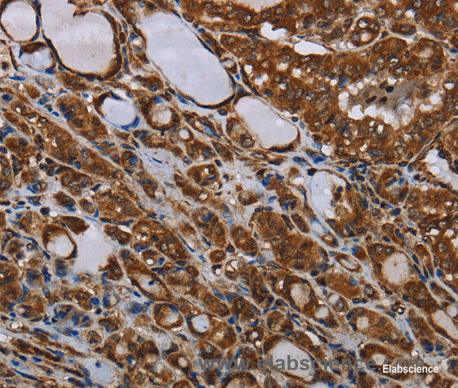 Immunohistochemistry of paraffin-embedded Human thyroid cancer tissue using MT-ND1 Polyclonal Antibody at dilution 1:30