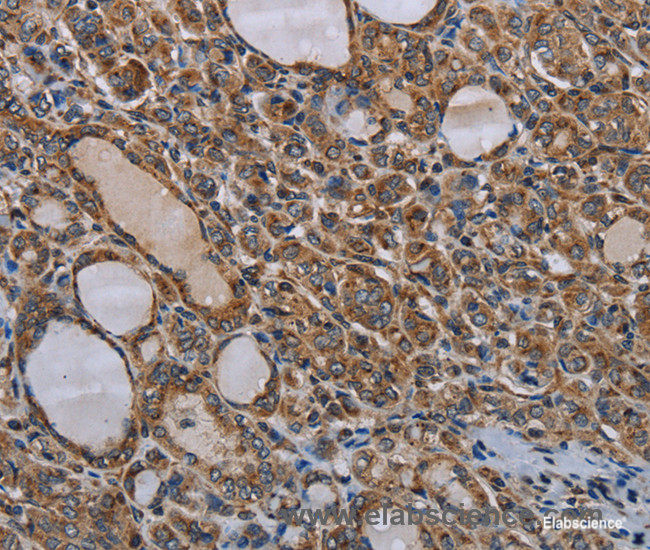 Immunohistochemistry of paraffin-embedded Human thyroid cancer tissue using MT-ND6 Polyclonal Antibody at dilution 1:40