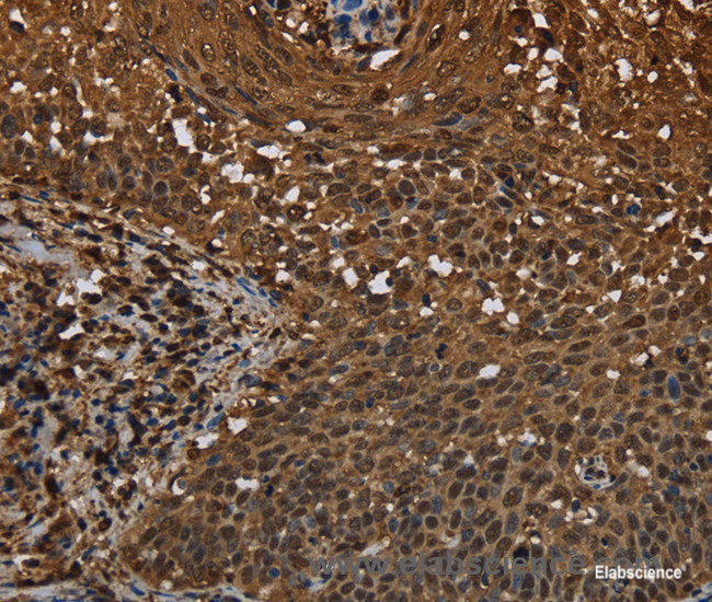 Immunohistochemistry of paraffin-embedded Human cervical cancer tissue using MYBBP1A Polyclonal Antibody at dilution 1:40