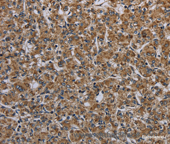 Immunohistochemistry of paraffin-embedded Human prostate cancer tissue using MYO7A Polyclonal Antibody at dilution 1:30