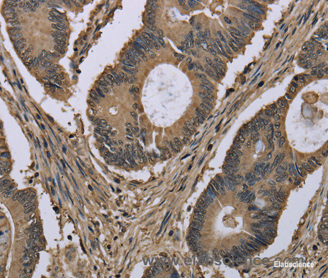 Immunohistochemistry of paraffin-embedded Human colon cancer tissue using MYO18B Polyclonal Antibody at dilution 1:50