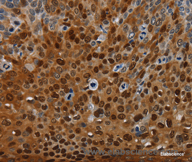 Immunohistochemistry of paraffin-embedded Human cervical cancer tissue using NRP2 Polyclonal Antibody at dilution 1:35