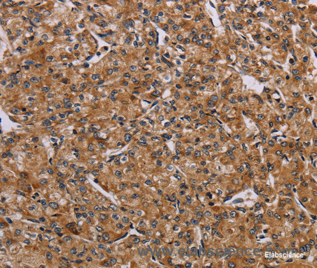 Immunohistochemistry of paraffin-embedded Human prostate cancer tissue using AATK Polyclonal Antibody at dilution 1:45