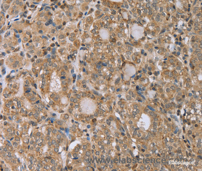 Immunohistochemistry of paraffin-embedded Human thyroid cancer tissue using RAB39B Polyclonal Antibody at dilution 1:45