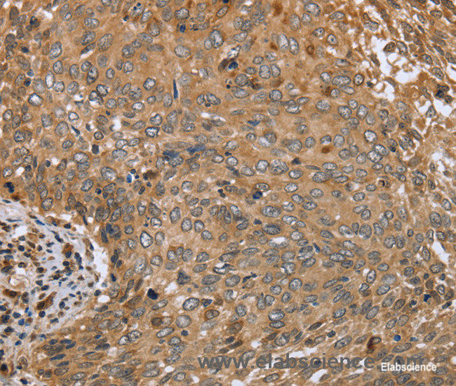 Immunohistochemistry of paraffin-embedded Human cervical cancer tissue using CLEC16A Polyclonal Antibody at dilution 1:45