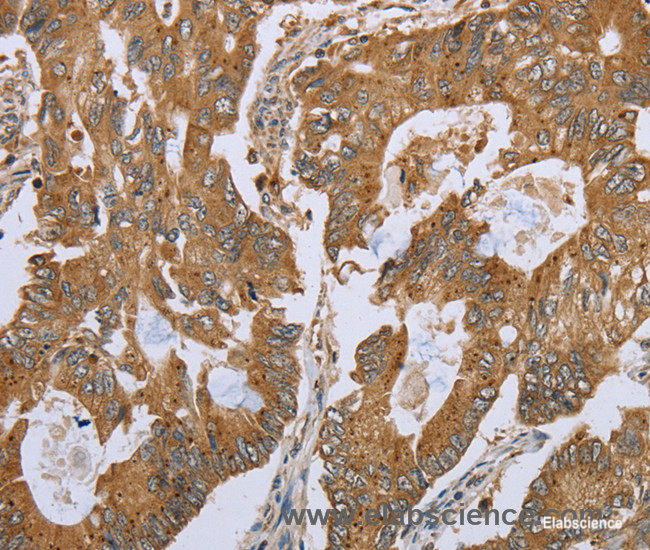 Immunohistochemistry of paraffin-embedded Human colon cancer tissue using NLRP10 Polyclonal Antibody at dilution 1:45
