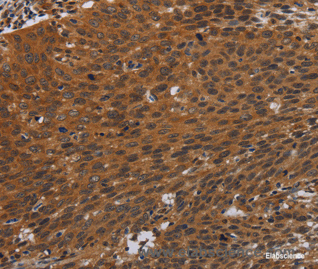 Immunohistochemistry of paraffin-embedded Human cervical cancer tissue using PNOC Polyclonal Antibody at dilution 1:40