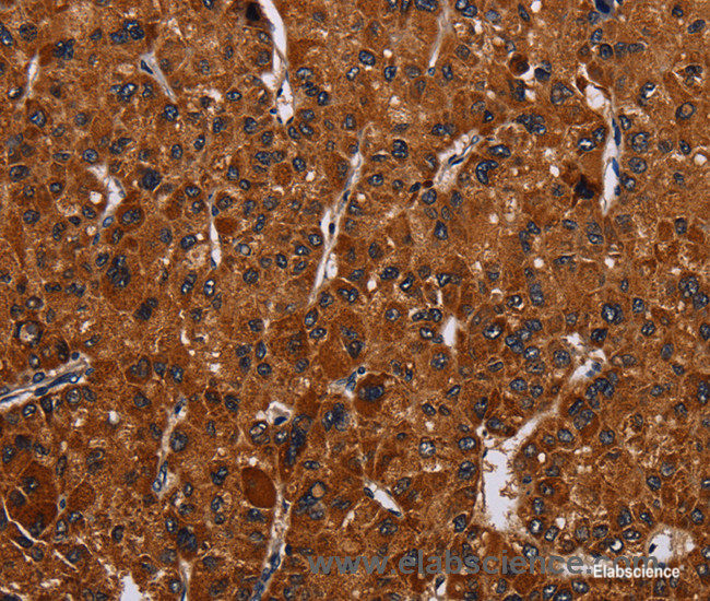 Immunohistochemistry of paraffin-embedded Human liver cancer tissue using RTN4R Polyclonal Antibody at dilution 1:50