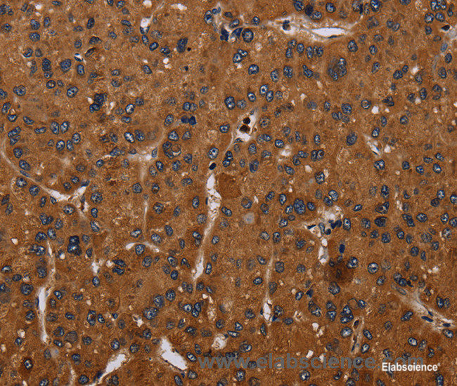 Immunohistochemistry of paraffin-embedded Human liver cancer tissue using CYBB Polyclonal Antibody at dilution 1:50