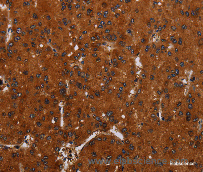 Immunohistochemistry of paraffin-embedded Human liver cancer tissue using NOX3 Polyclonal Antibody at dilution 1:30