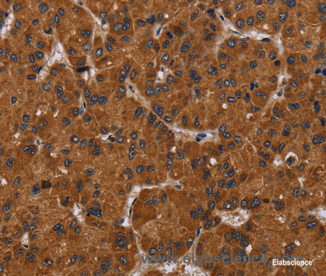 Immunohistochemistry of paraffin-embedded Human liver cancer tissue using NPHS2 Polyclonal Antibody at dilution 1:40