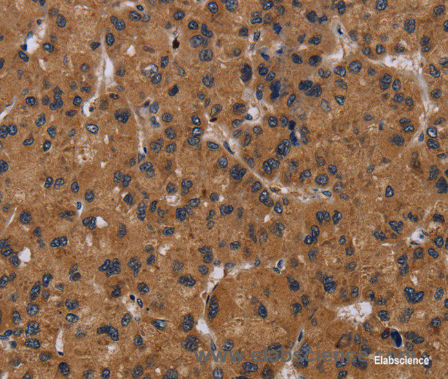 Immunohistochemistry of paraffin-embedded Human liver cancer tissue using NPRL2 Polyclonal Antibody at dilution 1:50