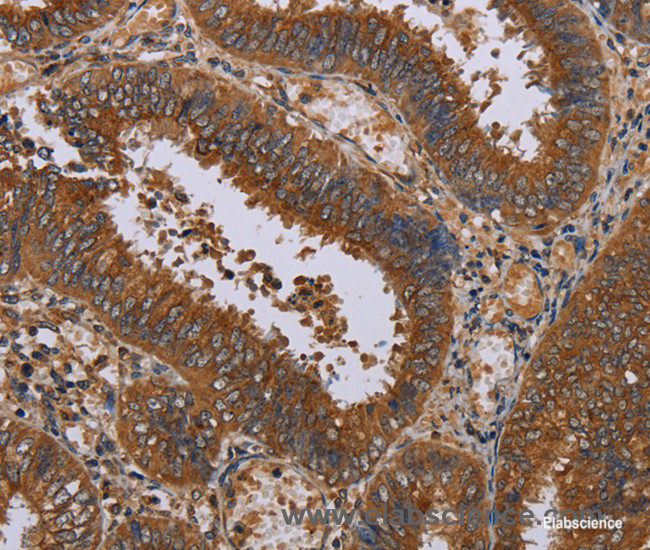 Immunohistochemistry of paraffin-embedded Human colon cancer tissue using NPTX1 Polyclonal Antibody at dilution 1:50