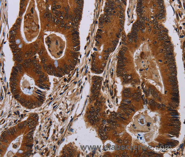 Immunohistochemistry of paraffin-embedded Human colon cancer tissue using DCAF6 Polyclonal Antibody at dilution 1:50