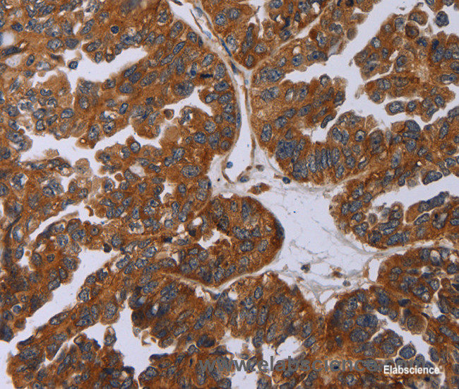 Immunohistochemistry of paraffin-embedded Human liver cancer tissue using P2RY2 Polyclonal Antibody at dilution of 1:30