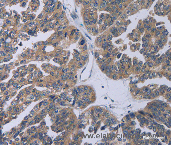 Immunohistochemistry of paraffin-embedded Human ovarian cancer tissue using TP53AIP1 Polyclonal Antibody at dilution 1:50