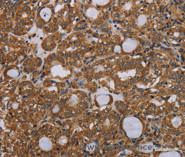 Immunohistochemistry of paraffin-embedded Human thyroid cancer tissue using PARP8 Polyclonal Antibody at dilution 1:40