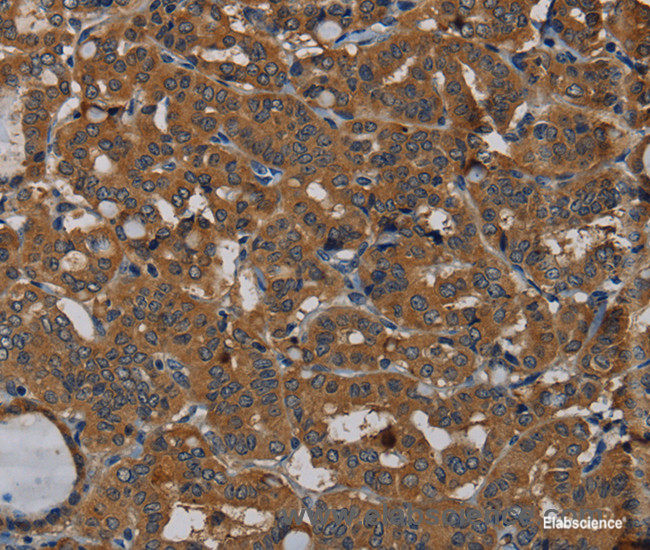 Immunohistochemistry of paraffin-embedded Human thyroid cancer tissue using PDE5A Polyclonal Antibody at dilution 1:50