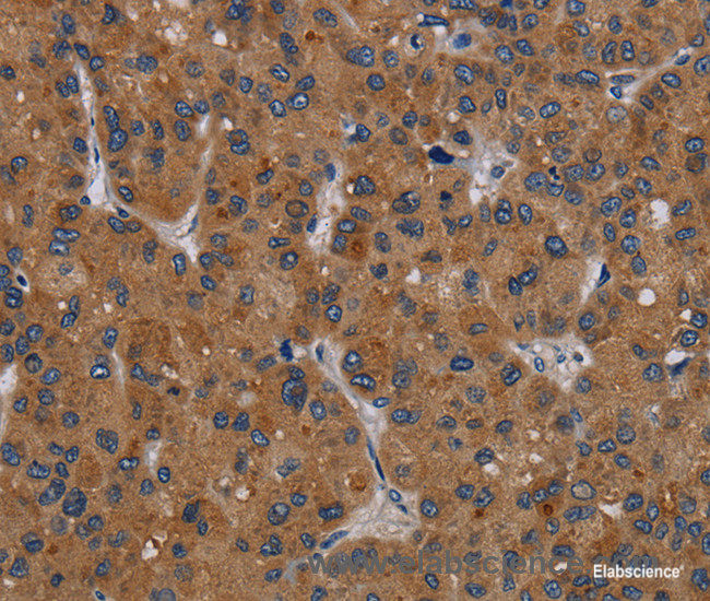 Immunohistochemistry of paraffin-embedded Human liver cancer tissue using PDGFC Polyclonal Antibody at dilution 1:40