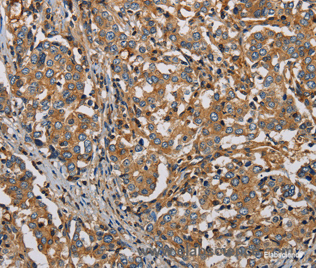 Immunohistochemistry of paraffin-embedded Human liver cancer tissue using PLIN3 Polyclonal Antibody at dilution 1:50