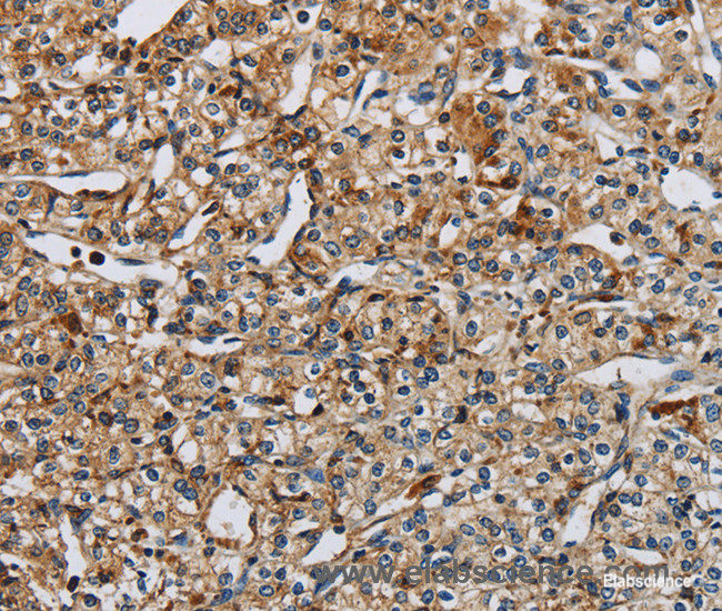 Immunohistochemistry of paraffin-embedded Human prostate cancer tissue using PERK Polyclonal Antibody at dilution 1:50