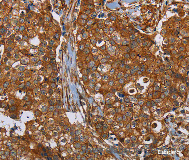 Immunohistochemistry of paraffin-embedded Human breast cancer tissue using PLEC Polyclonal Antibody at dilution 1:40