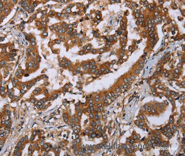 Immunohistochemistry of paraffin-embedded Human liver cancer tissue using PLXNB1 Polyclonal Antibody at dilution 1:50