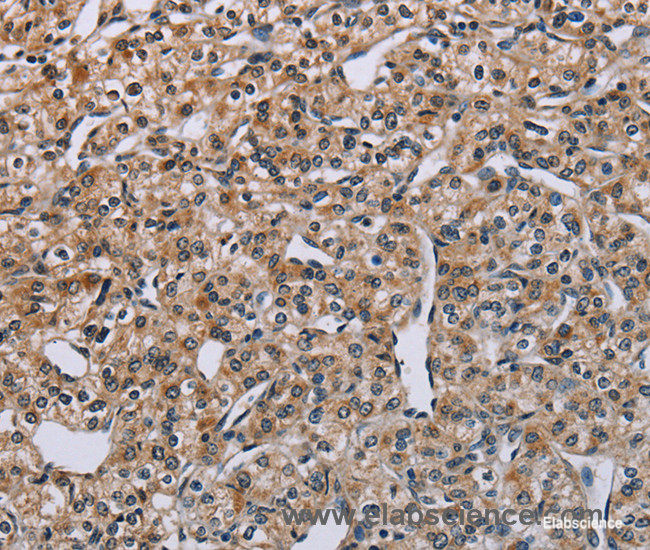 Immunohistochemistry of paraffin-embedded Human prostate cancer tissue using PNPT1 Polyclonal Antibody at dilution 1:40