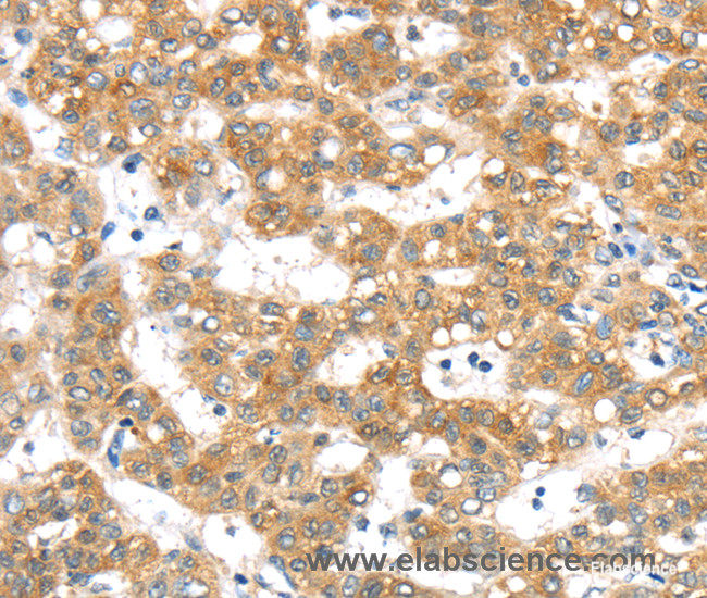Immunohistochemistry of paraffin-embedded Human cervical cancer tissue using PTPN4 Polyclonal Antibody at dilution 1:40