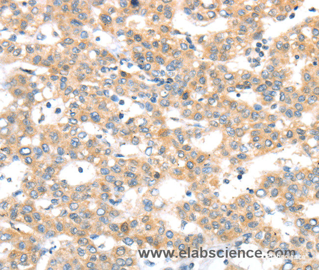 Immunohistochemistry of paraffin-embedded Human breast cancer tissue using RAB24 Polyclonal Antibody at dilution 1:45