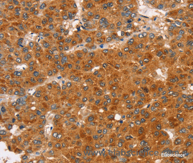 Immunohistochemistry of paraffin-embedded Human liver cancer tissue using RASA3 Polyclonal Antibody at dilution 1:35