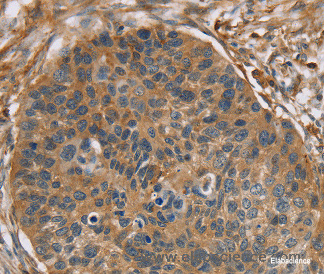 Immunohistochemistry of paraffin-embedded Human esophagus cancer tissue using RIPK4 Polyclonal Antibody at dilution 1:40