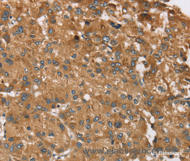 Immunohistochemistry of paraffin-embedded Human liver cancer tissue using RPS6KA2 Polyclonal Antibody at dilution 1:40