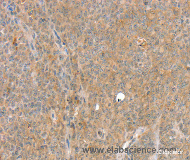 Immunohistochemistry of paraffin-embedded Human ovarian cancer tissue using SLC8A3 Polyclonal Antibody at dilution 1:35