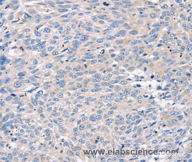 Immunohistochemistry of paraffin-embedded Human lung cancer tissue using ROR1 Polyclonal Antibody at dilution 1:35