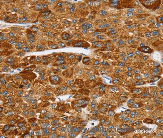 Immunohistochemistry of paraffin-embedded Human liver cancer tissue using SPARCL1 Polyclonal Antibody at dilution 1:30