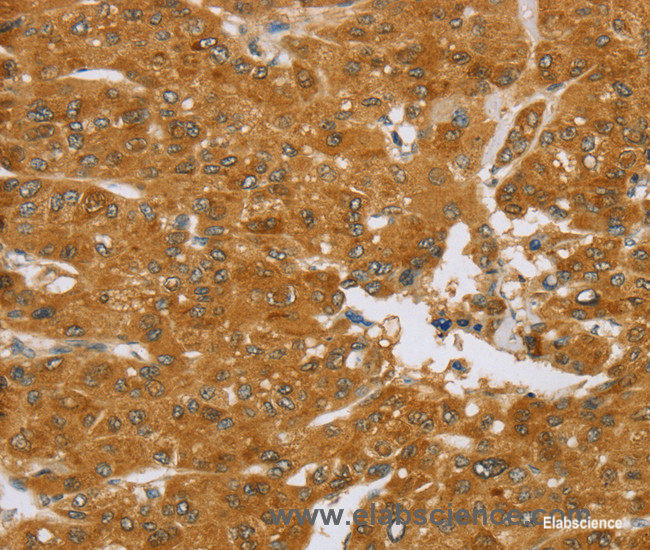 Immunohistochemistry of paraffin-embedded Human liver cancer tissue using TNFSF13 Polyclonal Antibody at dilution 1:40