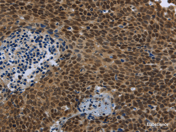 Immunohistochemistry of paraffin-embedded Human cervical cancer using SMAD4 Polyclonal Antibody at dilution of 1/40