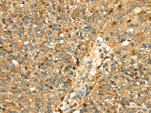 Immunohistochemistry of paraffin-embedded Human breast cancer tissue using Cathepsin H Polyclonal Antibody at dilution 1:50