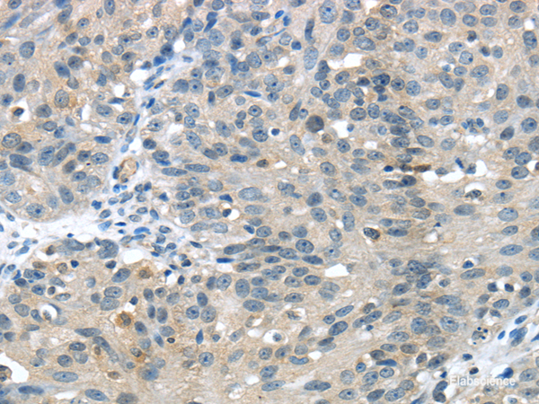Immunohistochemistry of paraffin-embedded Human breast cancer using GLP2R Polyclonal Antibody at dilution of  1/30