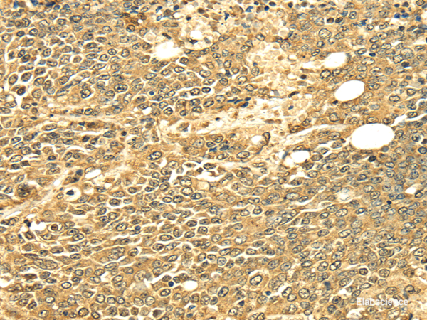 Immunohistochemistry of paraffin-embedded Human ovarian cancer using ECE2 Polyclonal Antibody at dilution of  1/25